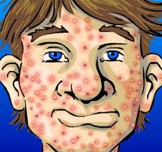 El acné consiste en la infección e inflamación de las glándulas sebáceas de la cara, cuello, pecho y espalda. Es mas frecuente en la adolescencia y en aquellos casos en […]